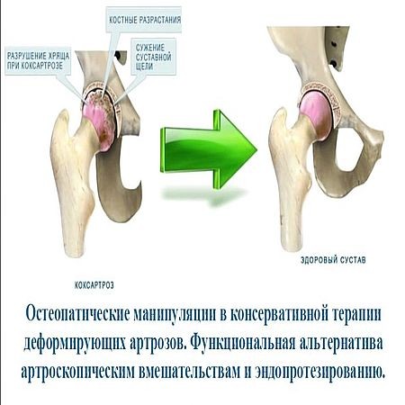 Стол при коксартрозе